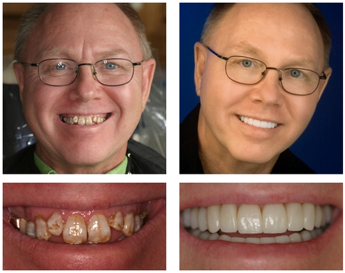 🦷 Jasseem® Custom-Fit Functional Dentures 😁 Smile with Confidence🍁💖