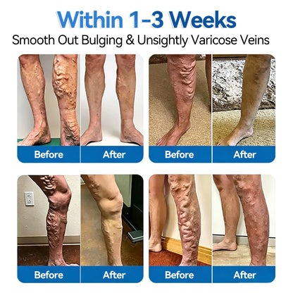 🍁💖𝐅𝐥𝐨𝐫𝐢𝐬𝐦𝐚® 𝐕𝐞𝐢𝐧𝐑𝐞𝐩𝐚𝐢𝐫 𝐌𝐢𝐜𝐫𝐨𝐧𝐞𝐞𝐝𝐥𝐞 𝐏𝐚𝐭𝐜𝐡 𝐑𝐨𝐥𝐥⚡Instant Relief, Long-Term Results