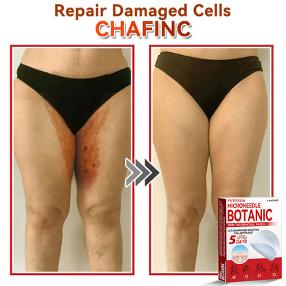 𝐅𝐀𝐓𝐎𝐍𝐆® 𝐌𝐢𝐜𝐫𝐨𝐍𝐞𝐞𝐝𝐥𝐞 𝐁𝐨𝐭𝐚𝐧𝐢𝐜 𝐒𝐤𝐢𝐧 𝐓𝐚𝐠 𝐑𝐞𝐦𝐨𝐯𝐚𝐥 𝐏𝐚𝐭𝐜𝐡 - Made in the U.K 🍁💖
