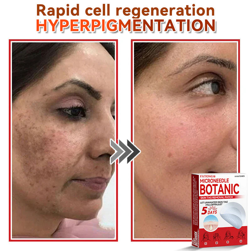 𝐅𝐀𝐓𝐎𝐍𝐆® 𝐌𝐢𝐜𝐫𝐨𝐍𝐞𝐞𝐝𝐥𝐞 𝐁𝐨𝐭𝐚𝐧𝐢𝐜 𝐒𝐤𝐢𝐧 𝐓𝐚𝐠 𝐑𝐞𝐦𝐨𝐯𝐚𝐥 𝐏𝐚𝐭𝐜𝐡 - Made in the U.K 🍁💖
