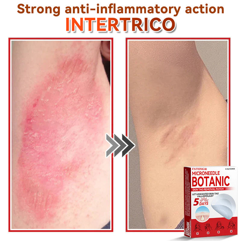 𝐅𝐀𝐓𝐎𝐍𝐆® 𝐌𝐢𝐜𝐫𝐨𝐍𝐞𝐞𝐝𝐥𝐞 𝐁𝐨𝐭𝐚𝐧𝐢𝐜 𝐒𝐤𝐢𝐧 𝐓𝐚𝐠 𝐑𝐞𝐦𝐨𝐯𝐚𝐥 𝐏𝐚𝐭𝐜𝐡 - Made in the U.K 🍁💖
